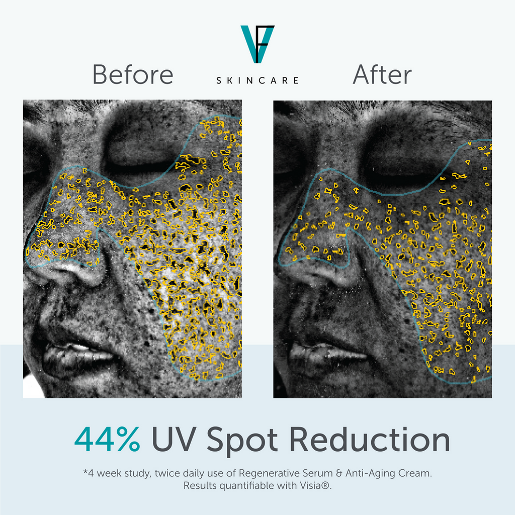 FACTORFIVE Anti-Aging Cream clinical UV spot results